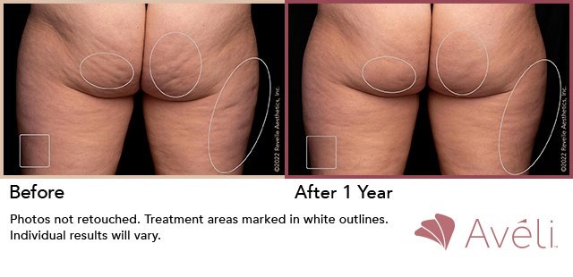 Aveli before and after, one year, thigh cellulite reduction